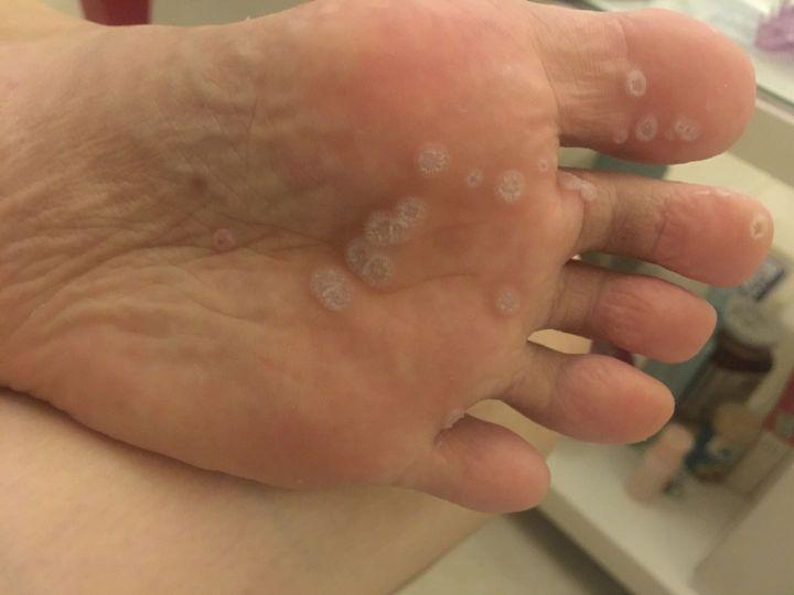 跖疣最简单的治疗方法,亲测有效