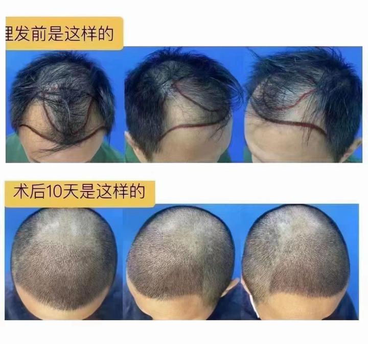 植发属于整形吗(植发属于整形吗还是整形)