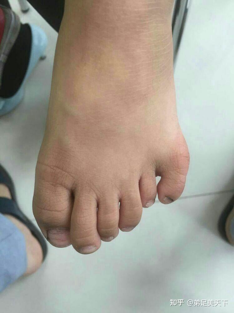 真的存在六个脚趾的人吗? - 知乎