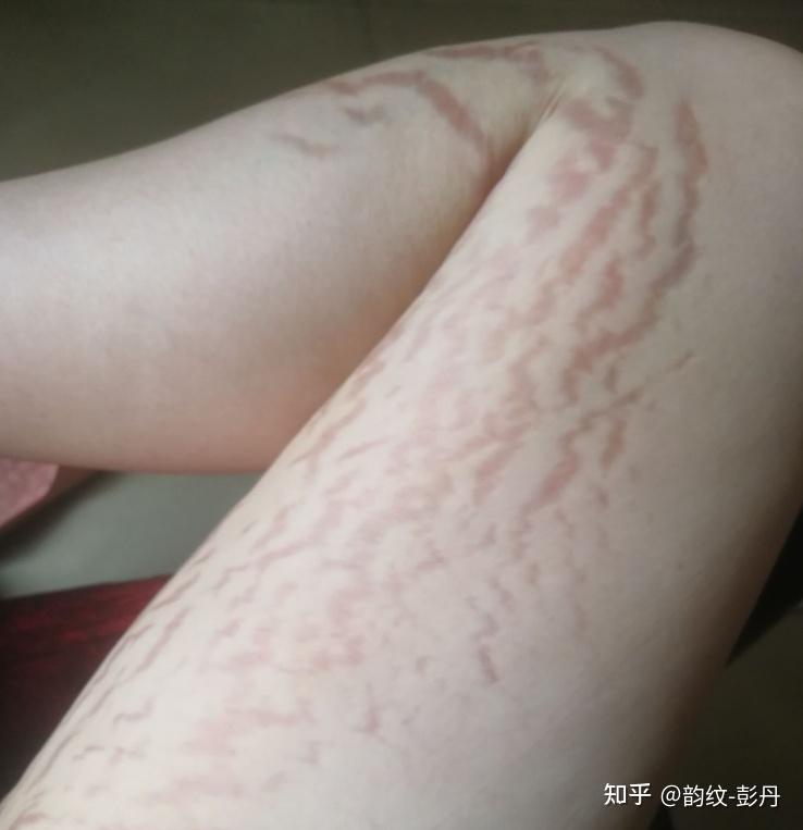 长肥胖纹是怎样一种体验?