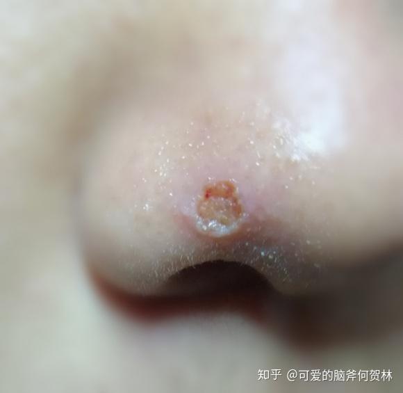 脸上有痣想去掉有没有好的办法