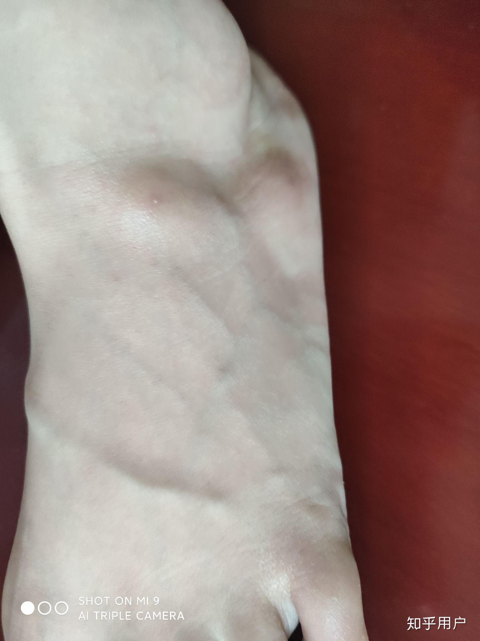 被蚂蚁咬了,伤口周围有硬物感,中间还有个小泡,今天是第三天了还没好