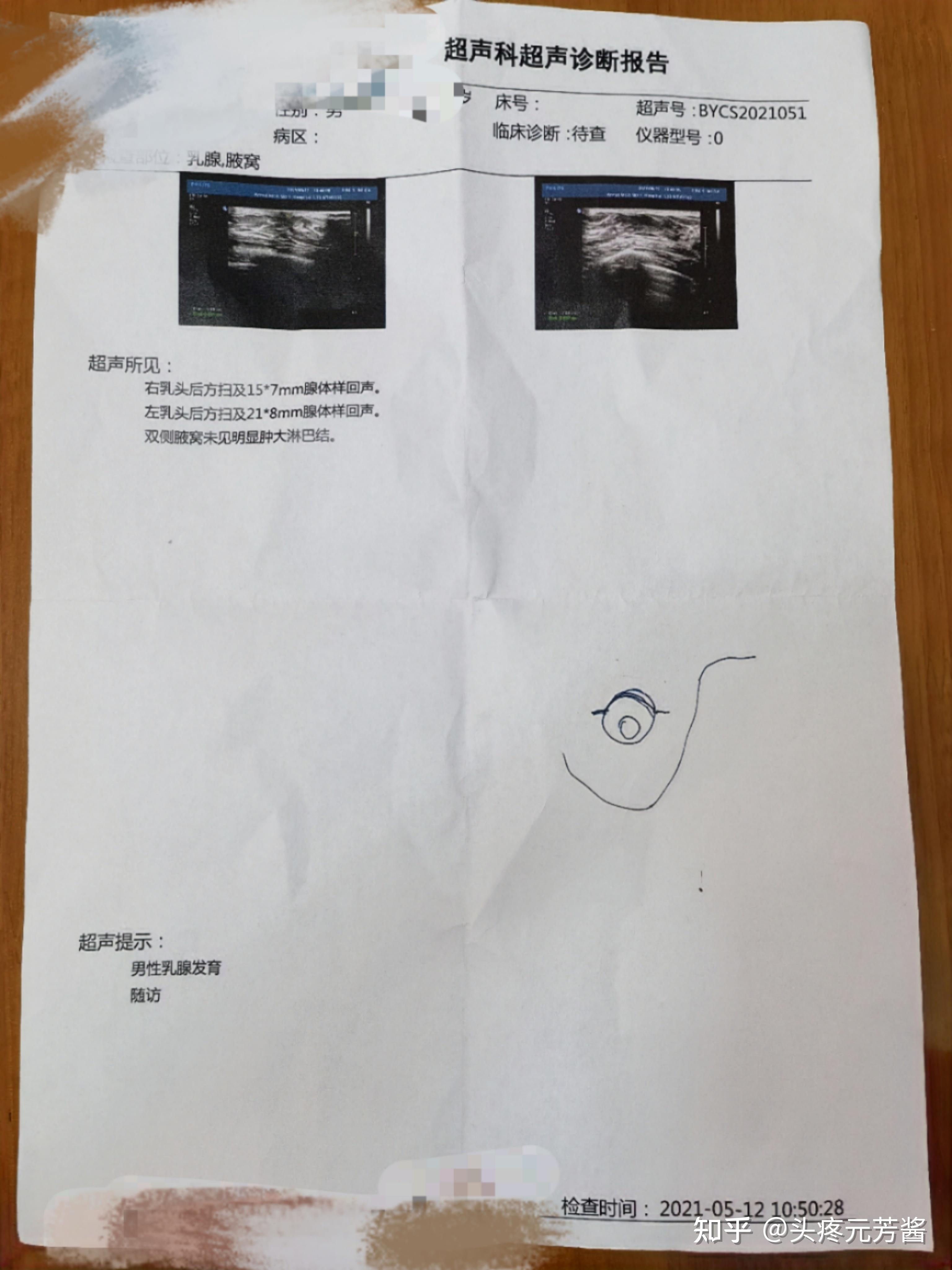 男性乳腺增生手术