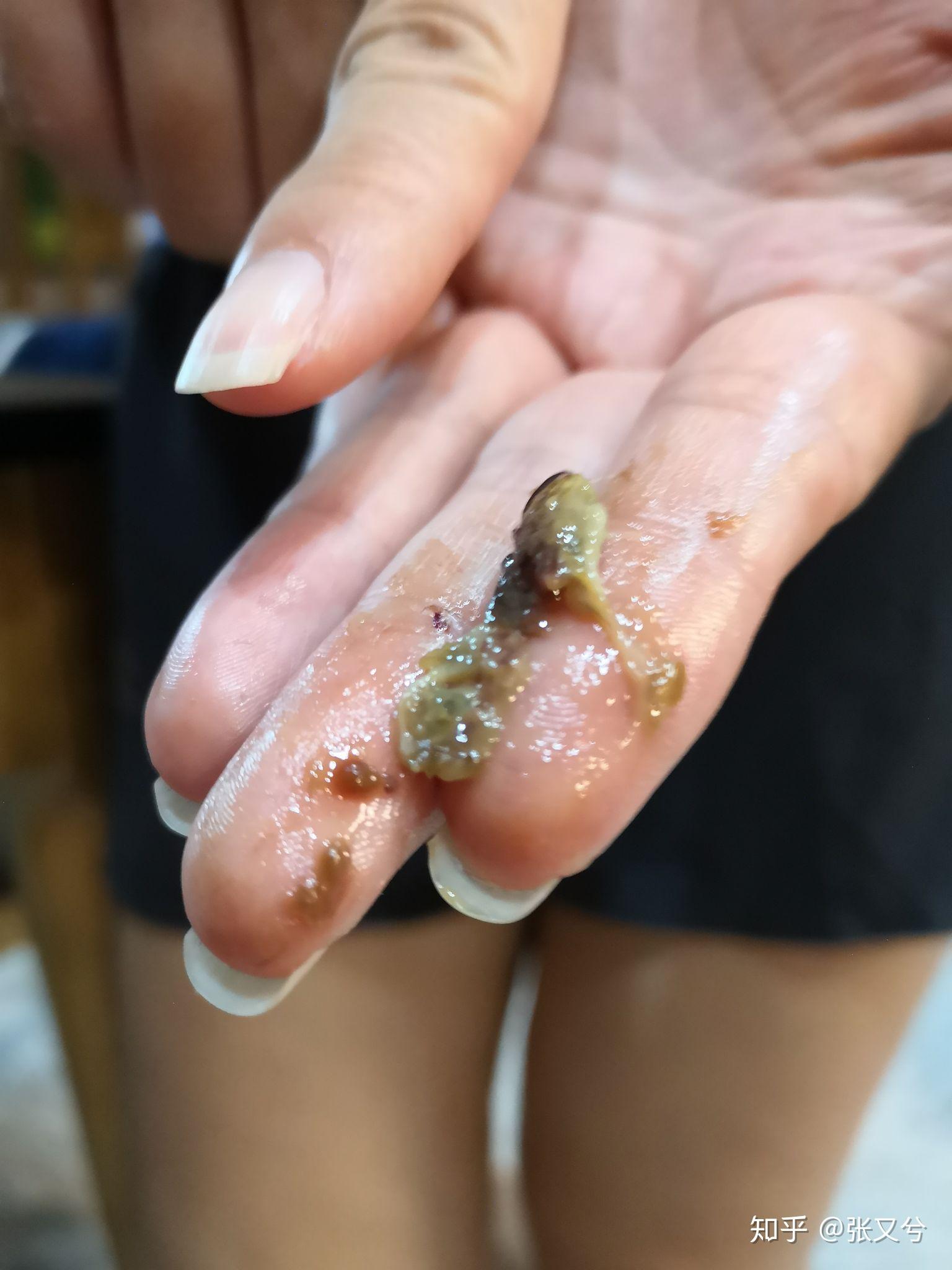 人的鼻屎能大到什么程度