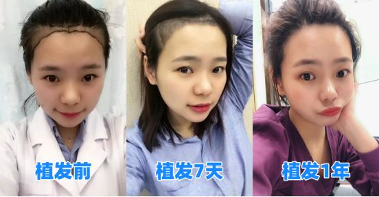 女生脱发绝望了想植发