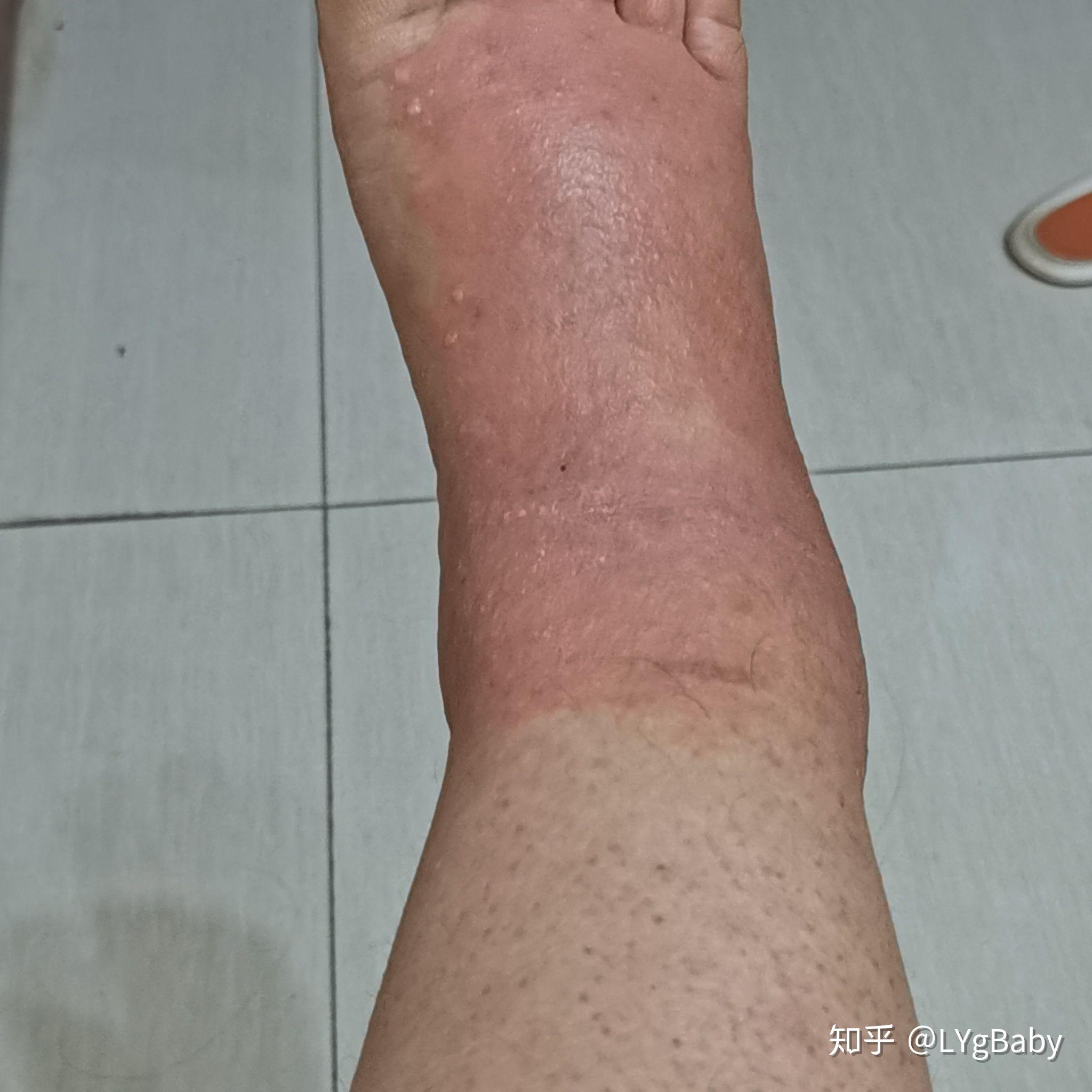 皮肤过敏起水泡怎么办
