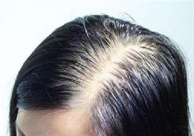 女生们,日常该如何护理发缝,发缝才不会越来越宽? - 知乎