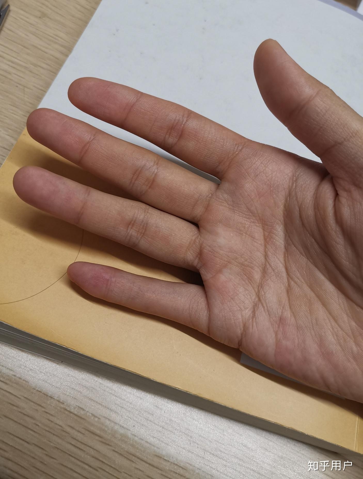 为什么有人双手小指天生只有两节