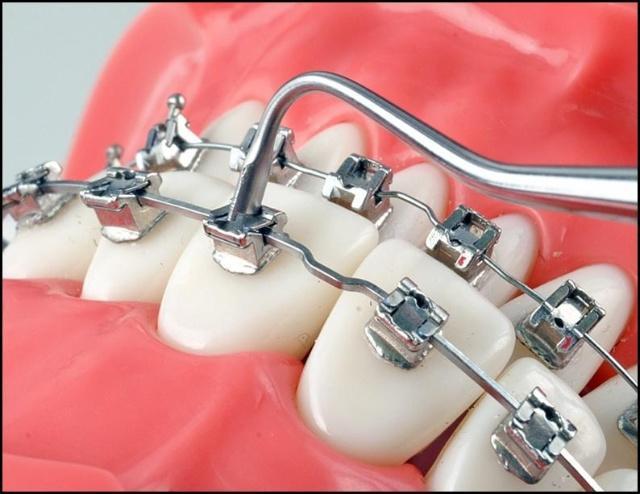 北京牙齿矫正一根钢丝是怎么把牙变整齐的