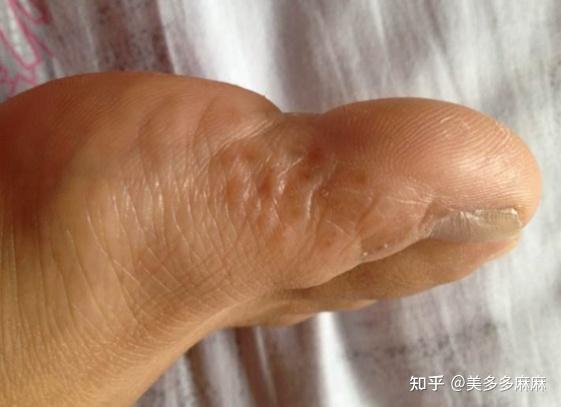 水泡型脚气的水泡,不要用针挑破,会扩散和加重.