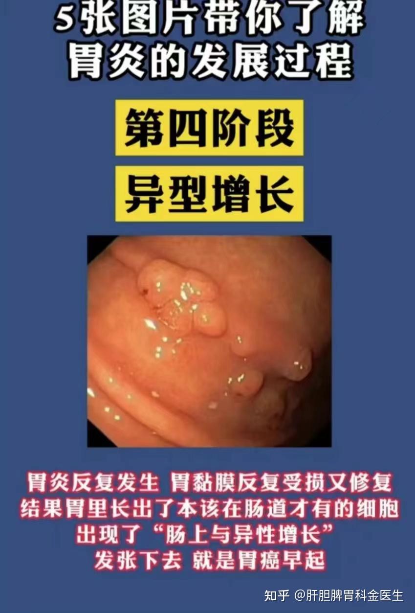 五张图带你了解胃炎发展过程 - 知乎