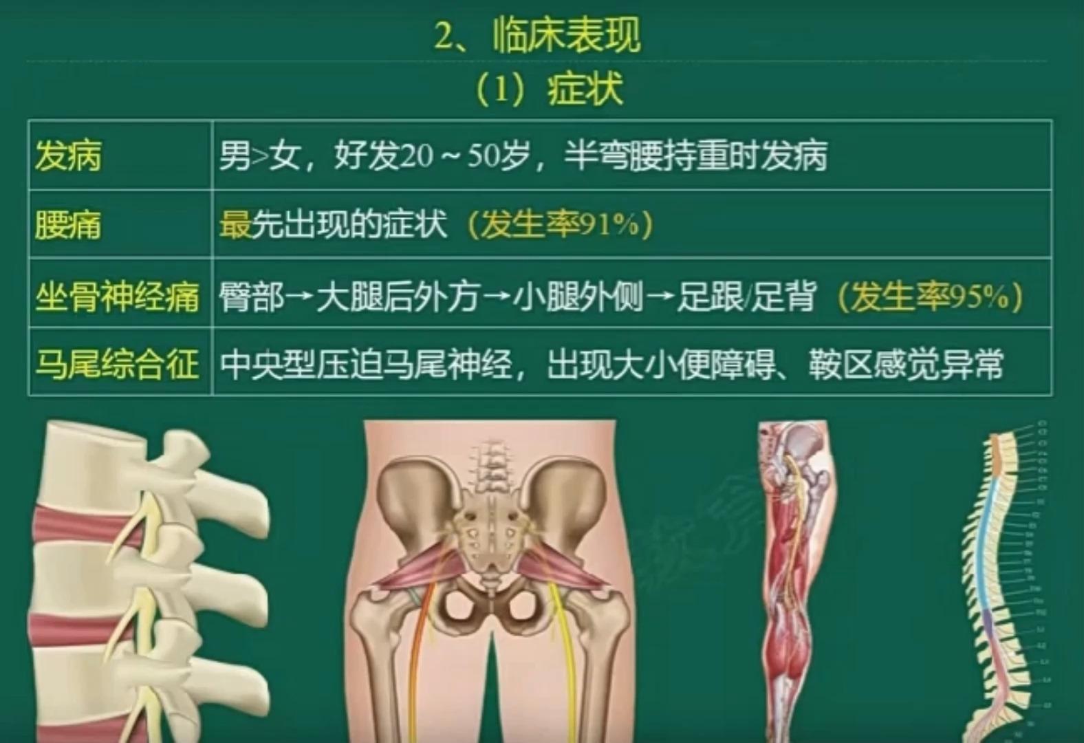 腰椎间盘突出疾病都有哪些症状表现?