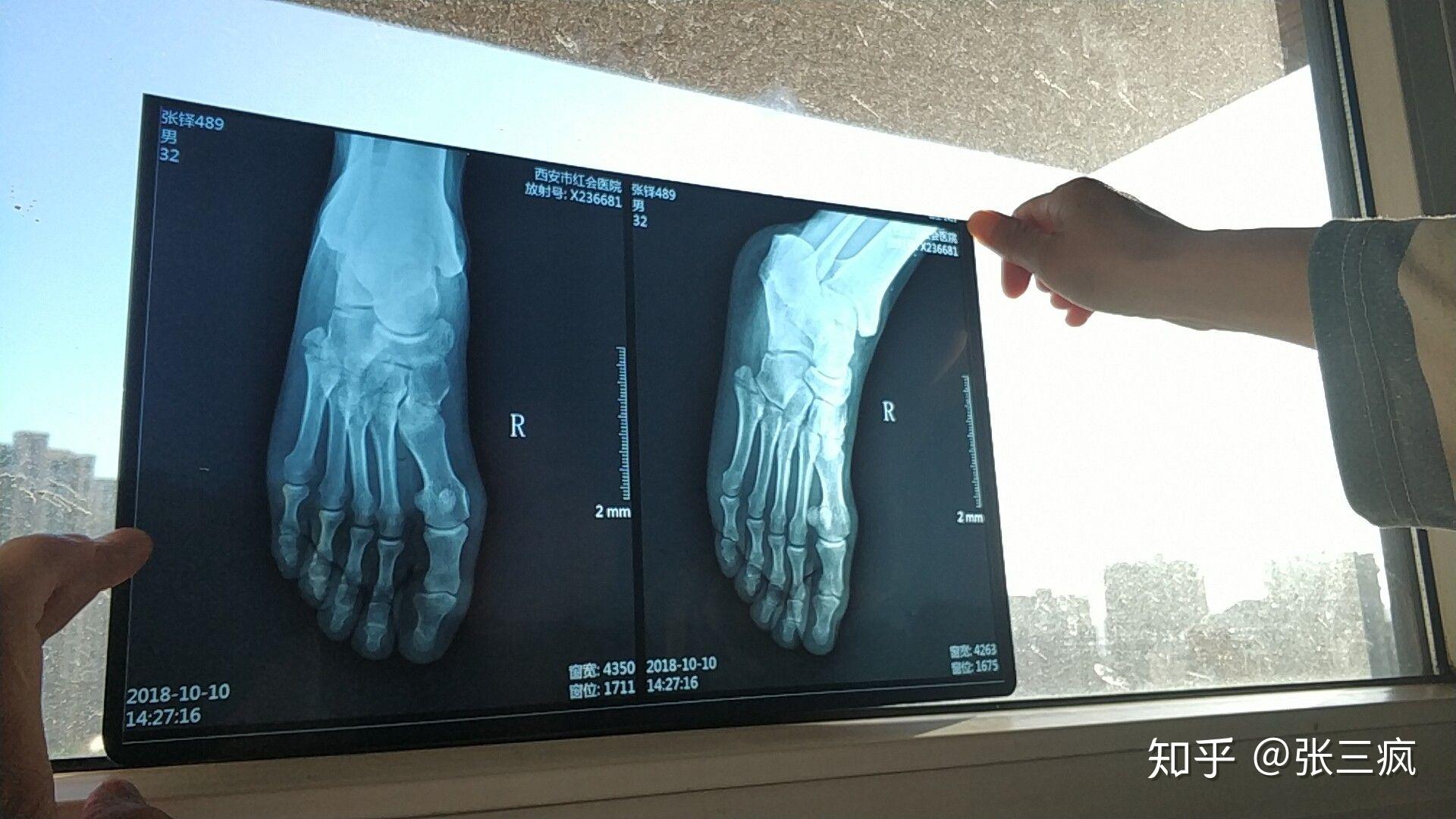 右脚第五跖骨骨折,有错位,必须手术吗?