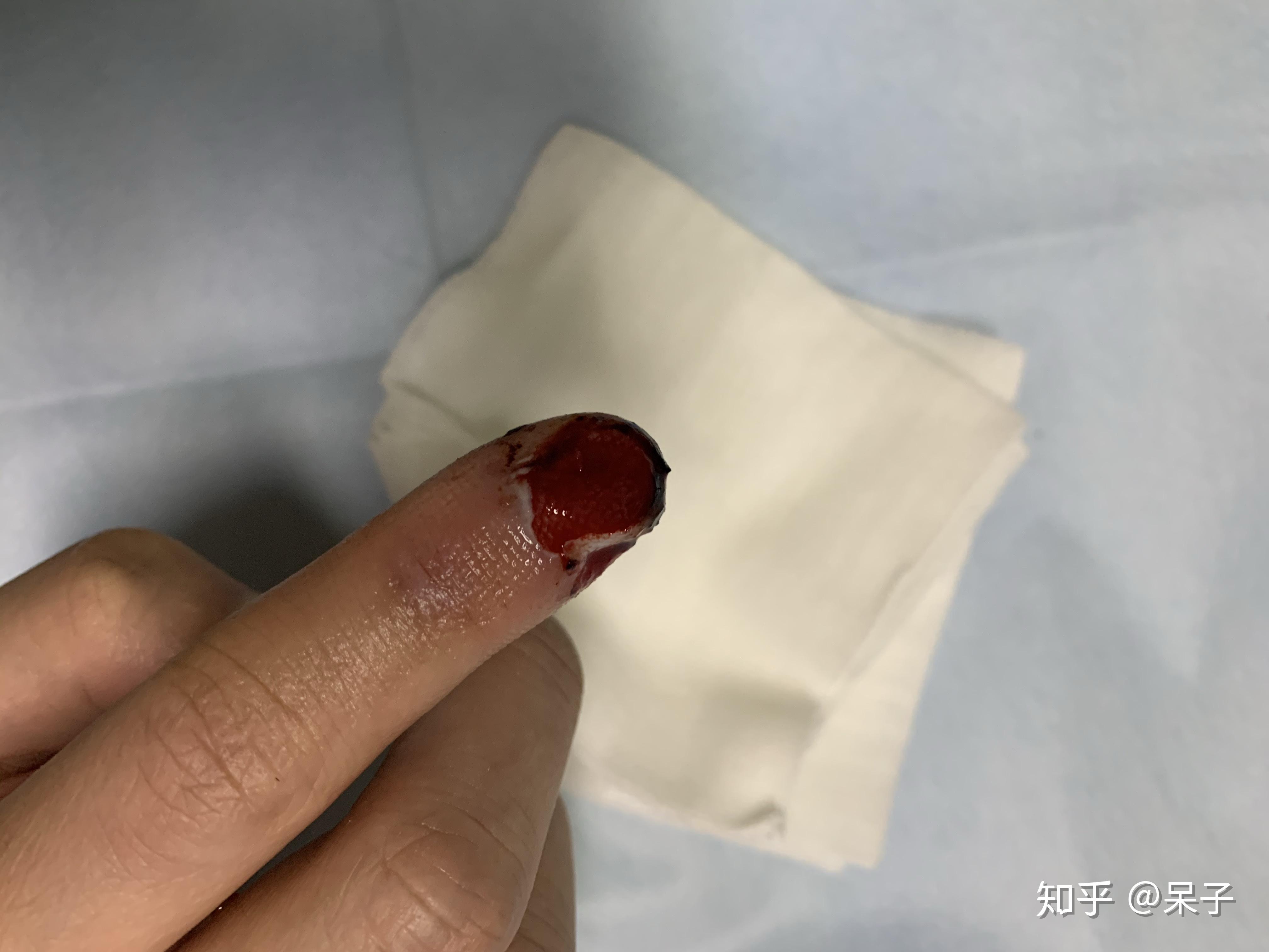 指甲盖被掀开三分之一是什么样的体验? - 知乎