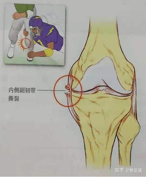 膝盖内侧副韧带撕裂怎么康复治疗? - 知乎