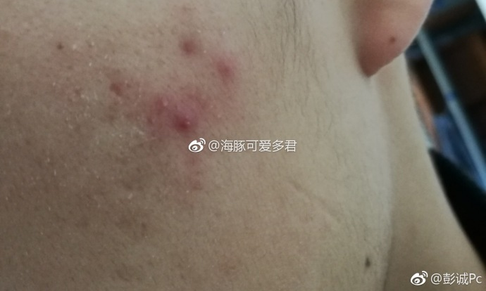 你知道你痤疮的类型吗？粉刺型？丘疹型还是囊肿型？各种不同的处理方法和注意事项？ - 知乎