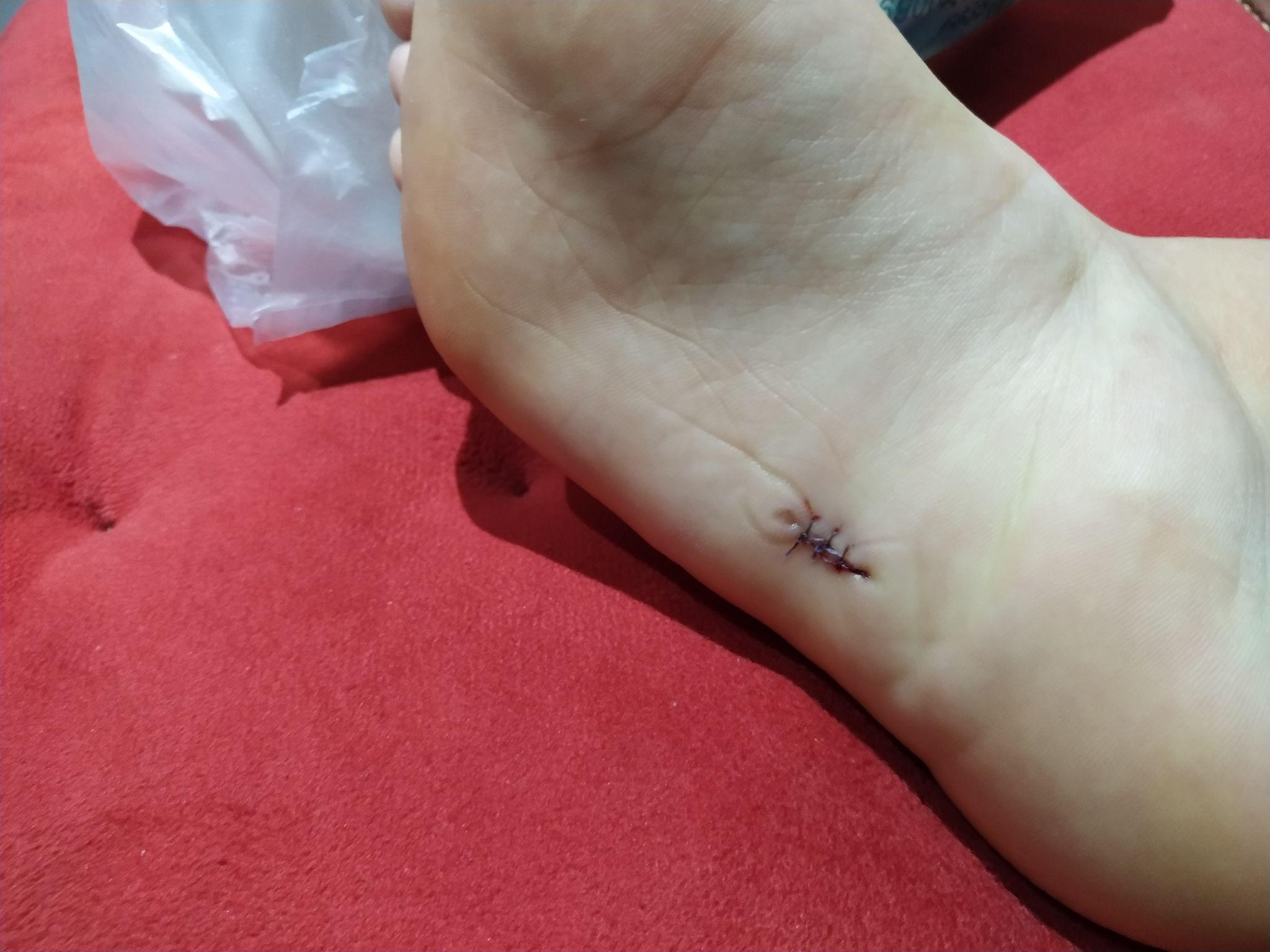 手术切脚底痣是怎么样的体验? - 知乎