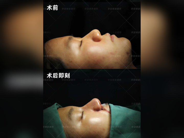 深圳初鼻鼻综合|面中凹陷 + 大鼻头 + 嘴凸,一次手术直接改掉骨相! - 知乎