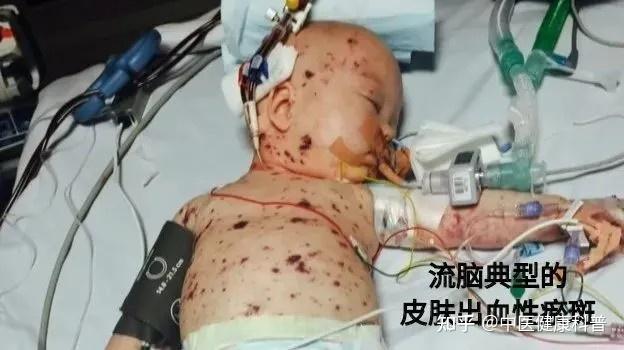 青海西宁一中学2名同班初中生22天内因脑膜炎先后离世感染后有哪些