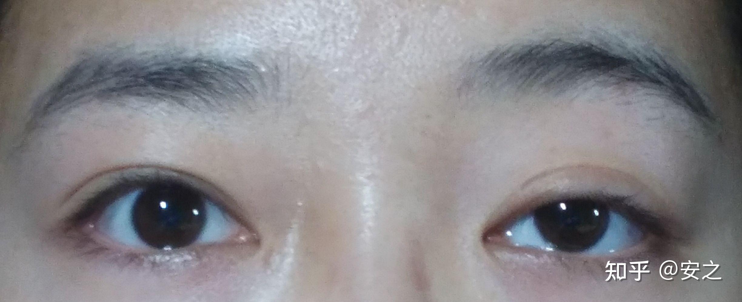 上眼睑下垂怎么办