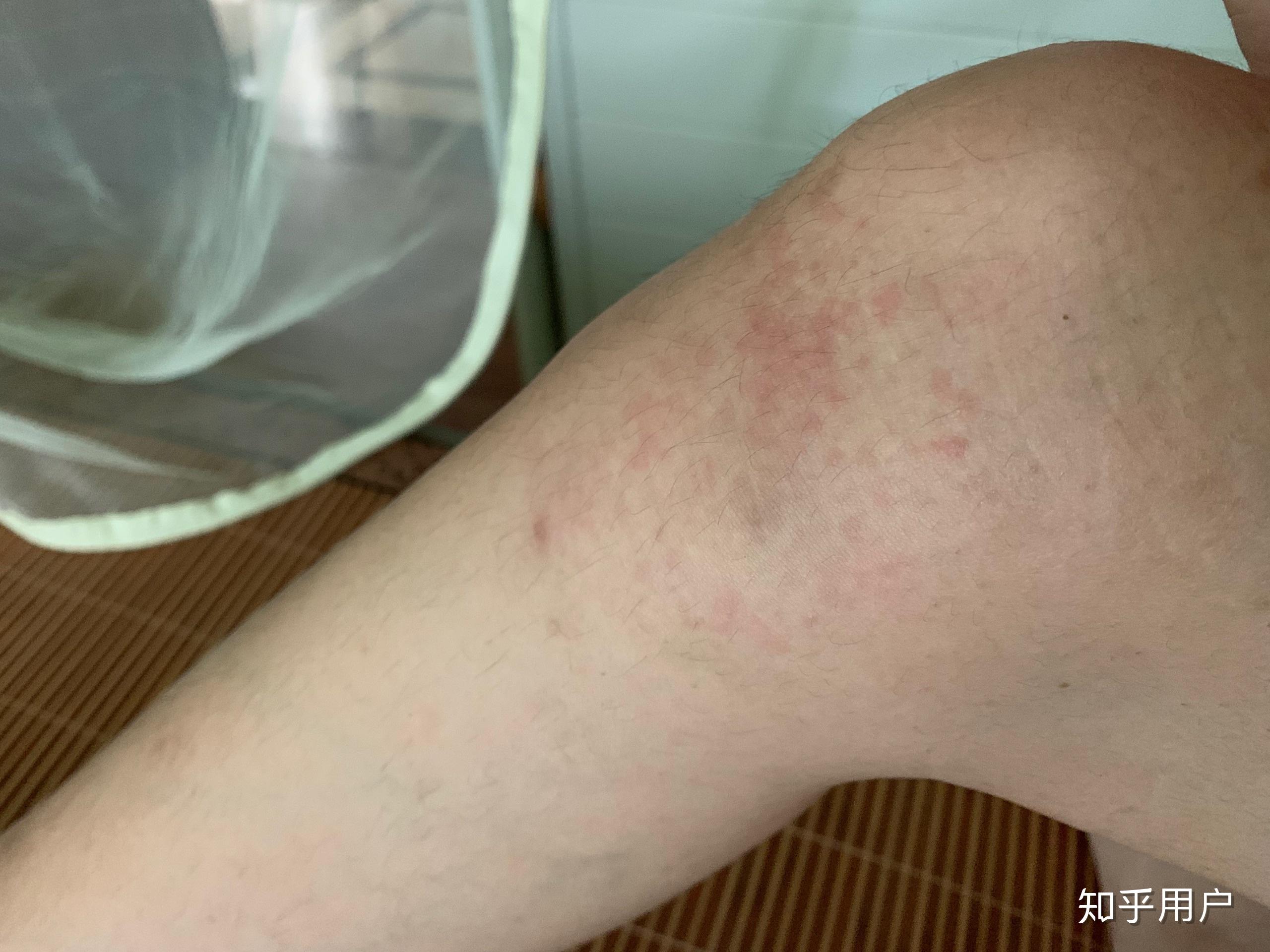 贴膏药过敏怎么办