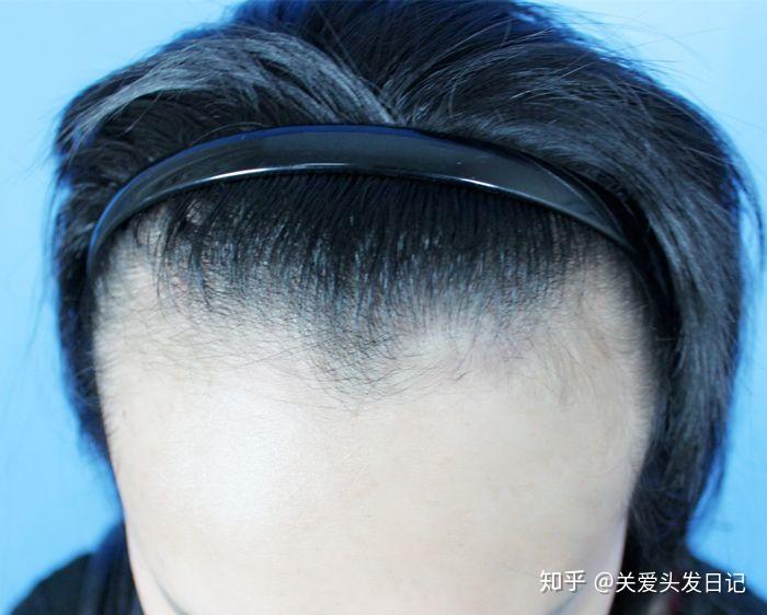 发际线上移怎么办