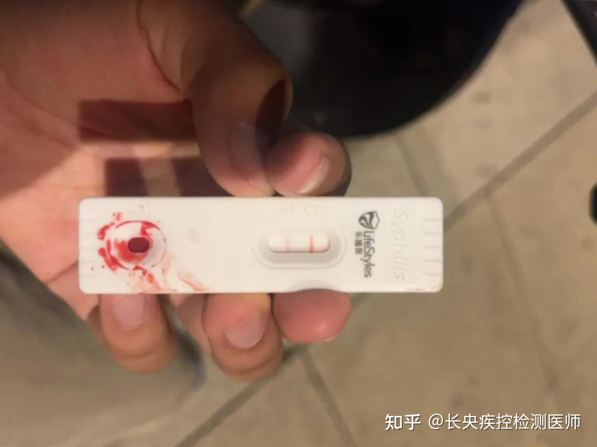 梅毒自测多久就排除了?