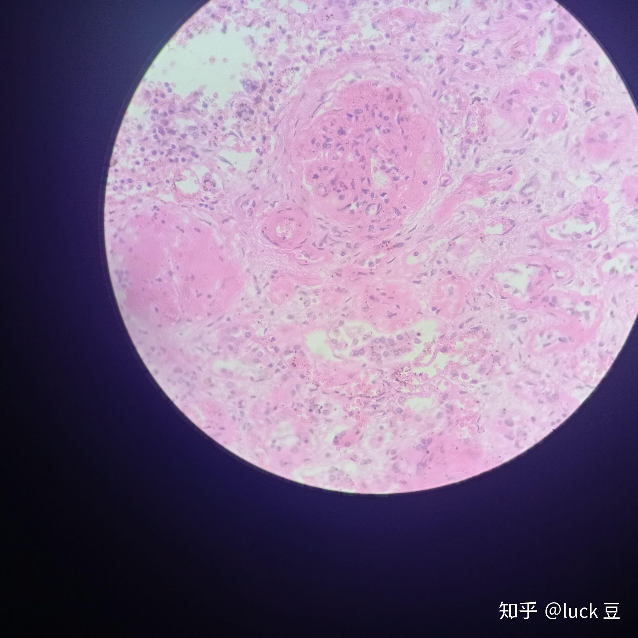 慢性肾小球肾炎手绘图是怎样的