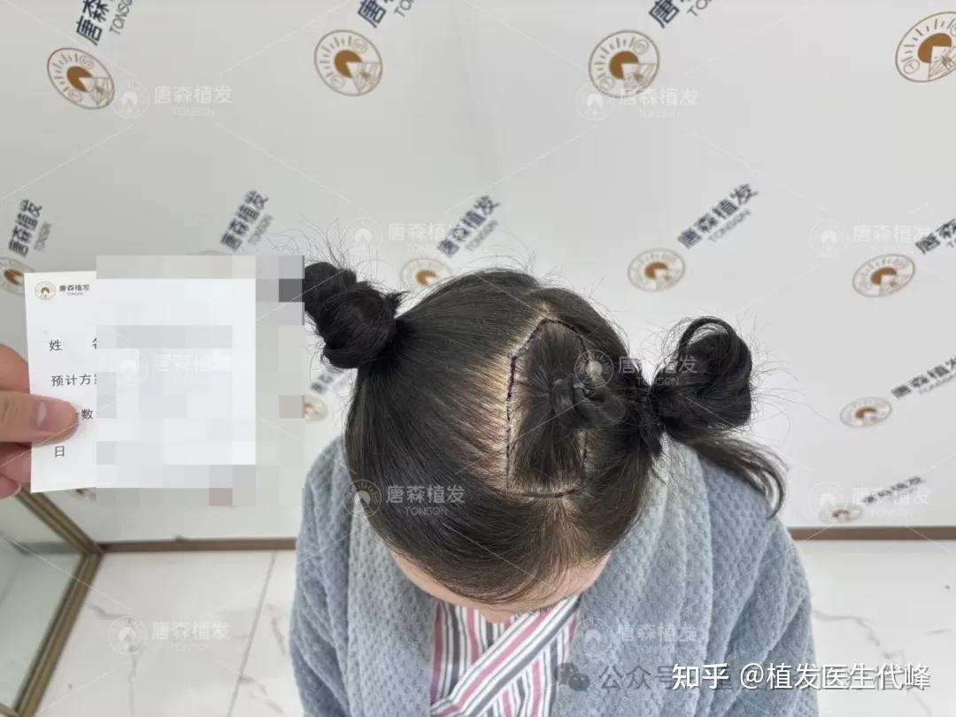 女生的发缝越来越宽怎么办？除了植发还有别的方法吗？ - 知乎