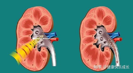 右肾有下盏6×7mm肾结石,需要怎么治疗? - 知乎