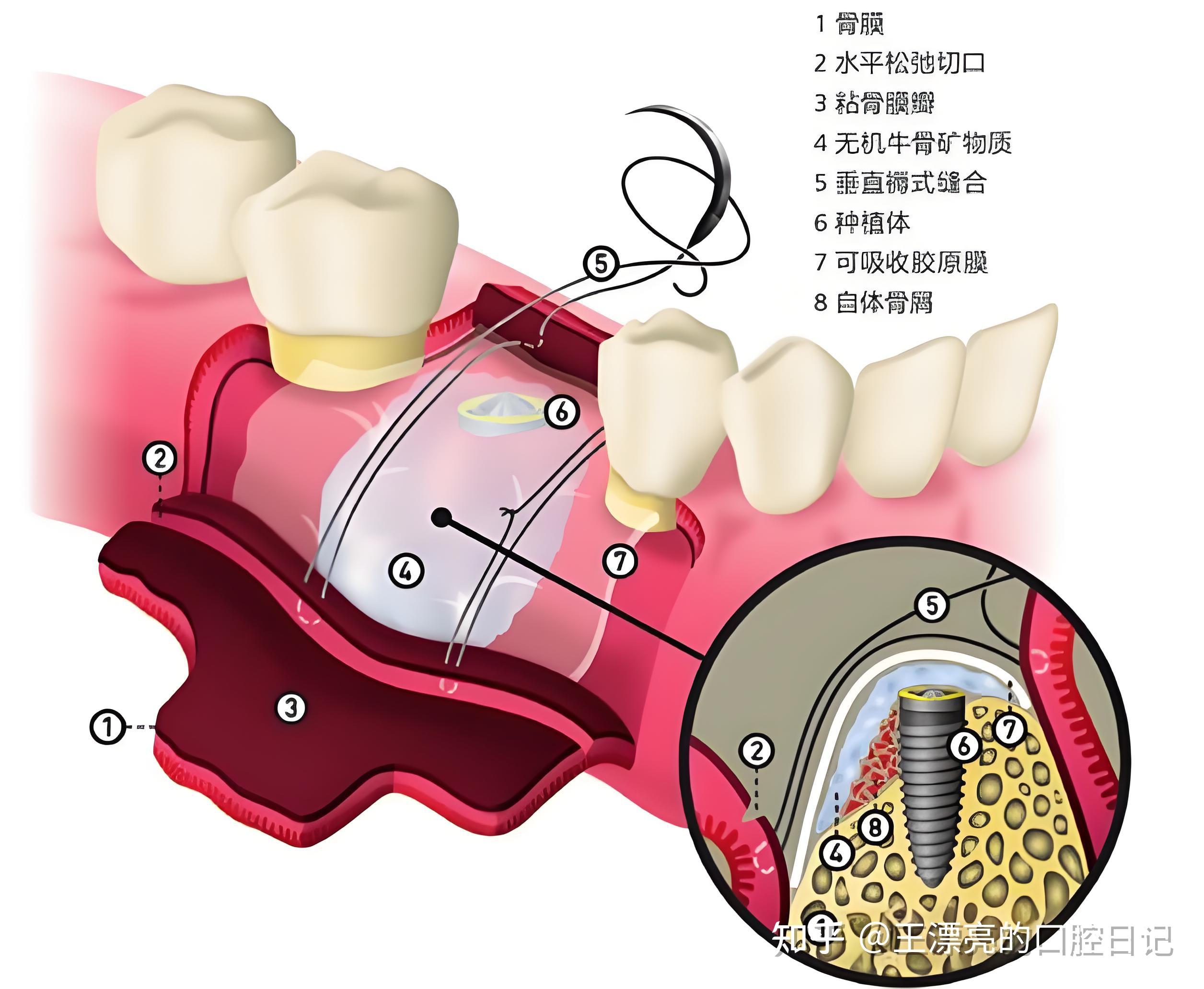 做种植牙植骨痛苦吗