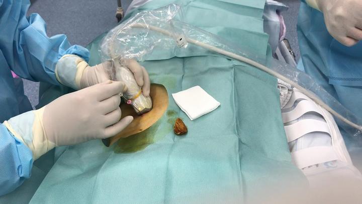 超声引导下徒手同轴肾穿刺活检术 视频