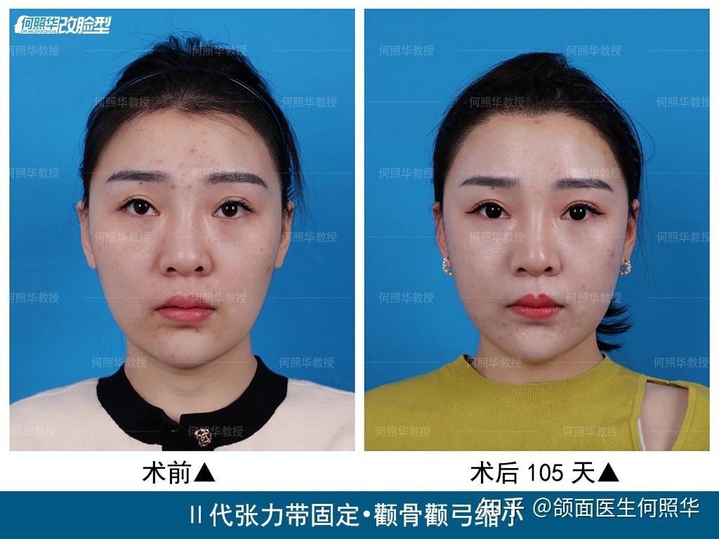 颧骨突出的原因有哪些 ？ - 知乎