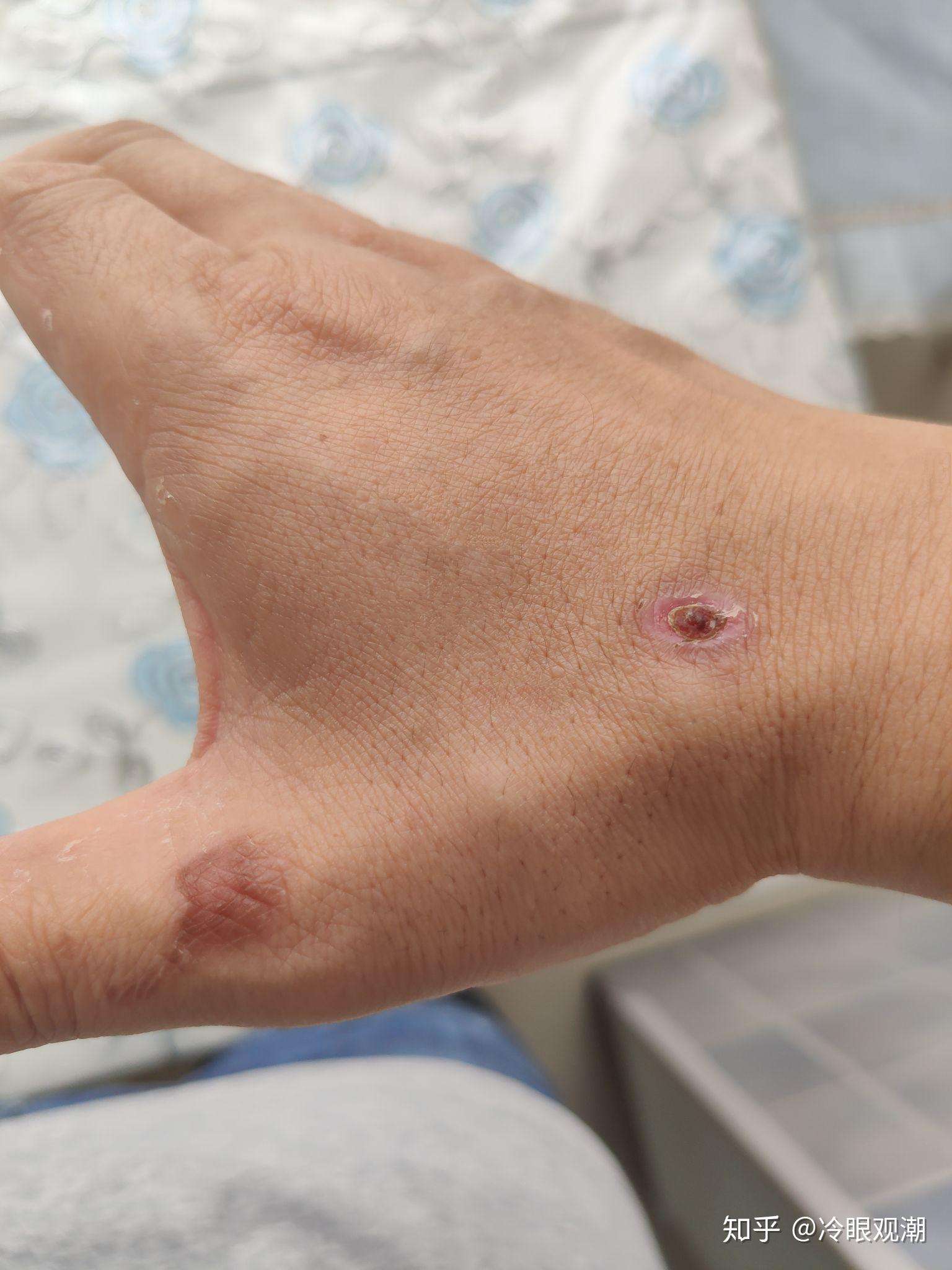 手烫伤了怎么办,起泡了? - 知乎
