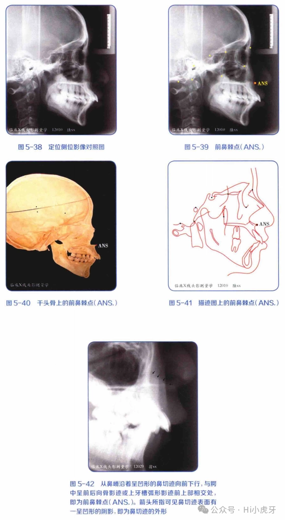 《临床X线 头影测量学》读书笔记（五）——常用头颅定位侧位影像测量标志点 - 知乎