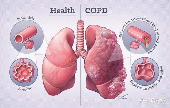 对于慢性阻塞性肺病患者copd家庭长期氧疗ltot时间应大于15小时每天