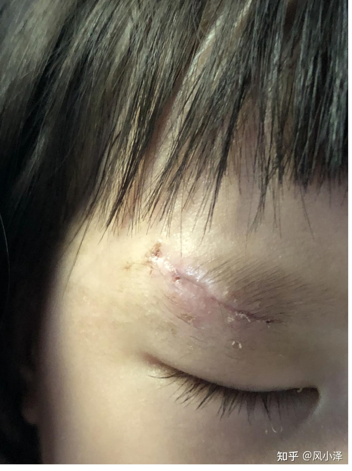宝宝磕伤手术缝针过程及手术后抗疤痕恢复记录 - 知乎