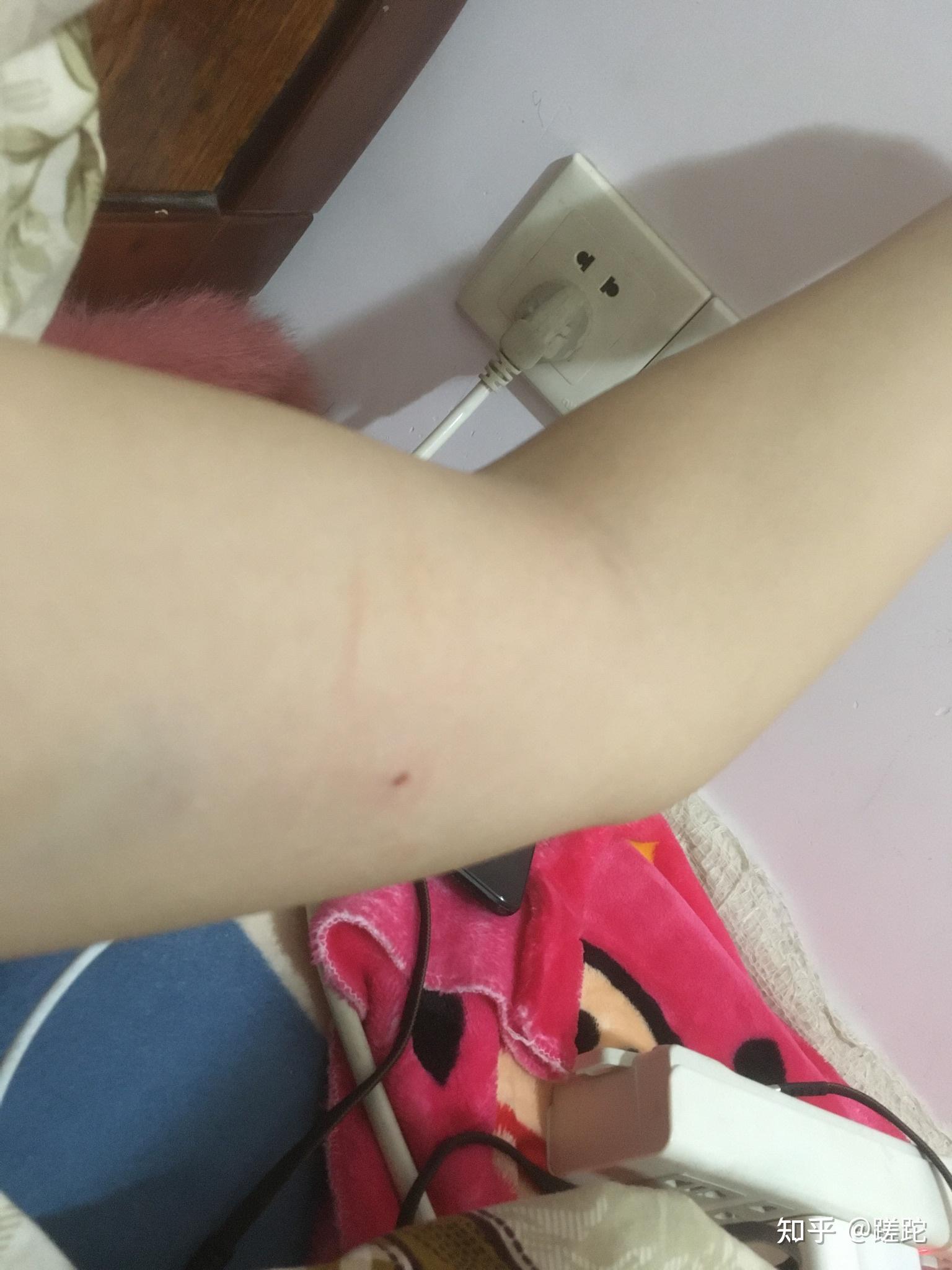 有小伙伴试过皮下埋植避孕法implant吗是怎么样的体验有怎样的不良