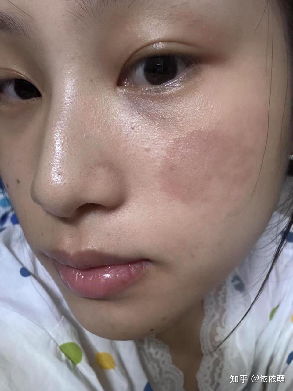 脸上长了湿疹怎么做才不会留黑印?