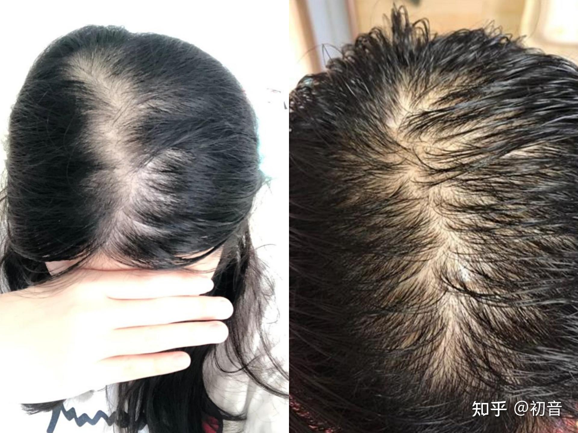 女生脂溢性脱发怎么办(女性脂溢性脱发能治好吗)