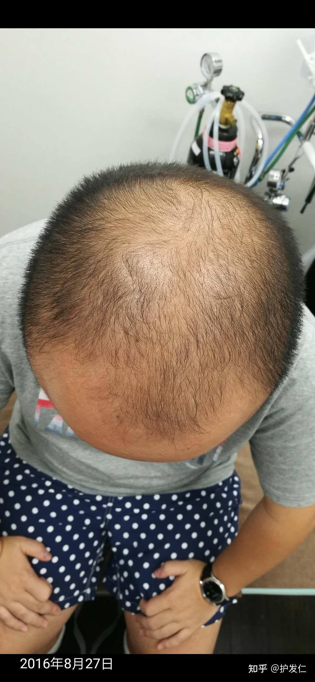 20岁男生这算脱发迹象了吗