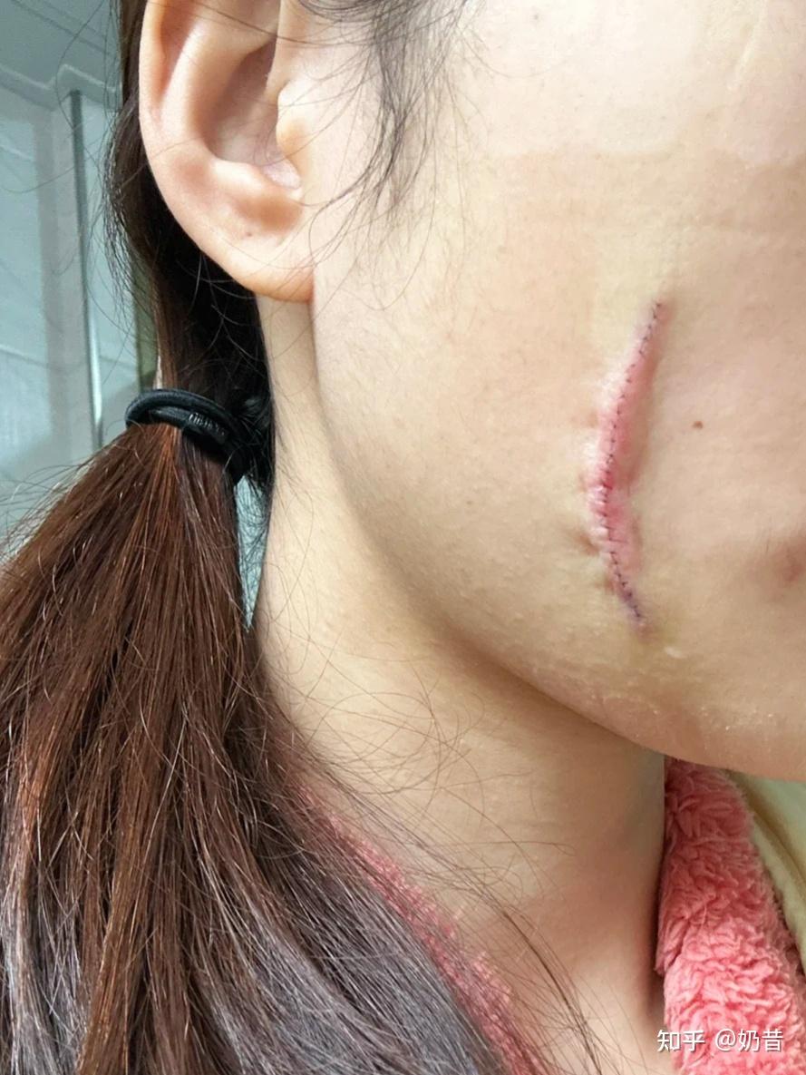 脸上缝针疤痕怎么去除?