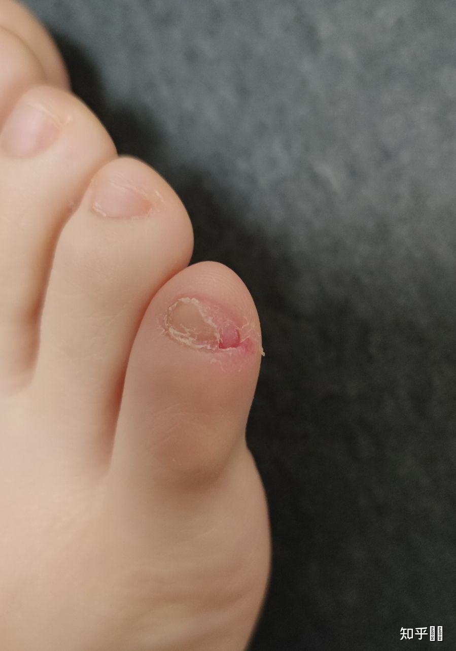 小脚趾甲有两瓣有办法可以把它去除吗? - 知乎
