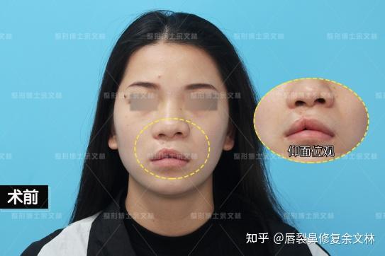 23岁兔唇女孩,希望可以拥有普通人的烦恼! - 知乎