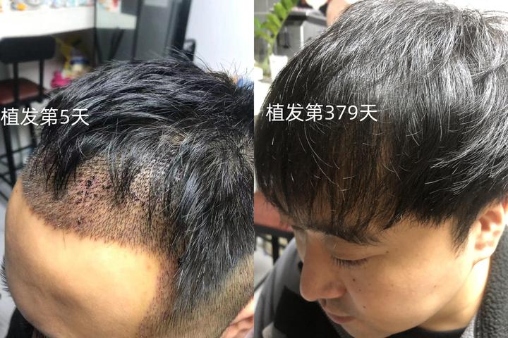 秃头与植发(秃头植发后效果什么样)