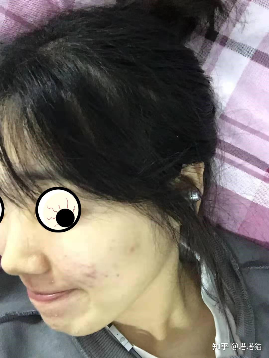 姐妹们能不能给我安利一下去痘印的药之类的啊啊啊啊啊啊我要崩溃了?