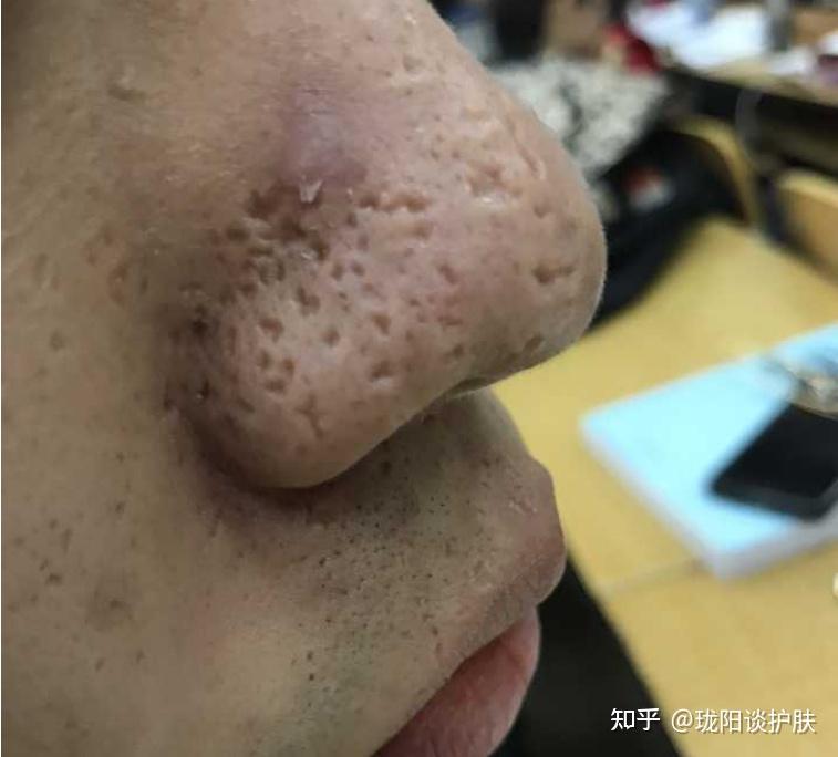 黑头是怎么形成的?为什么总是挤了又长?怎么消除? - 知乎