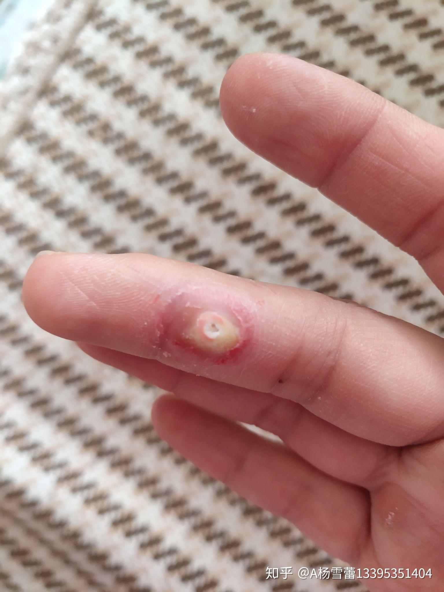 刺猴可以用鸡眼膏吗? - 知乎