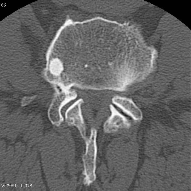 什么是骨岛,体检报告提示骨岛怎么办?