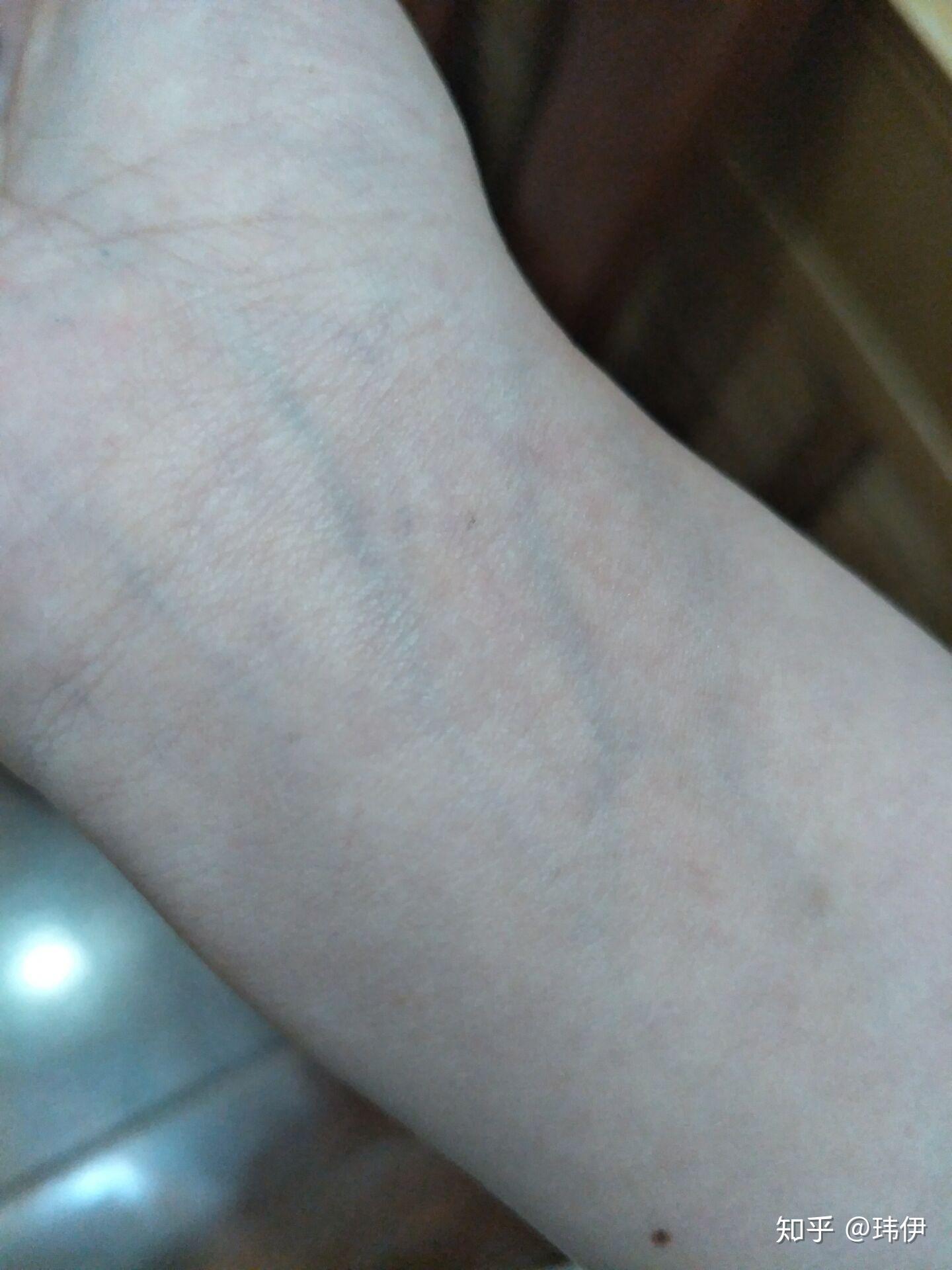 手腕上静脉颜色很明显,是身体有什么病症的原因吗? - 知乎